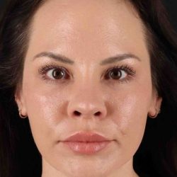 Buccal Fat Pad Before & After Patient #1425