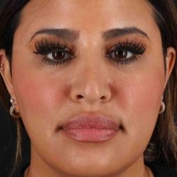Rhinoplasty Before & After Patient #3324