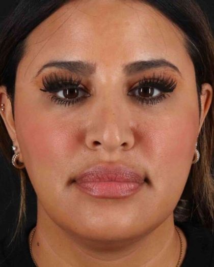 Rhinoplasty Before & After Patient #3324
