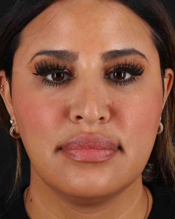 Rhinoplasty Before & After Patient #3324