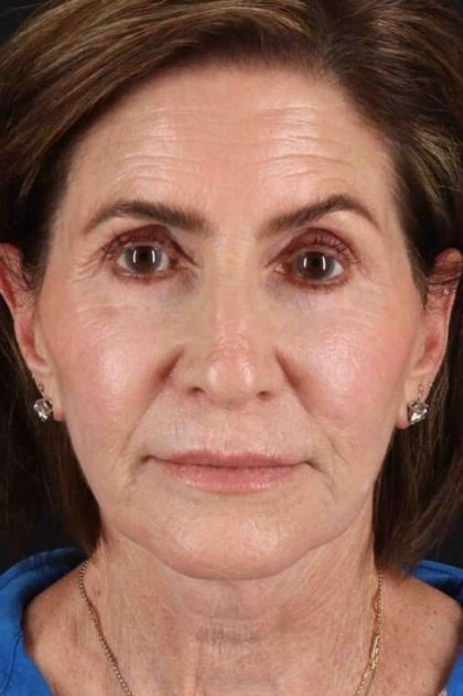 Co2 Laser Before & After Patient #3346