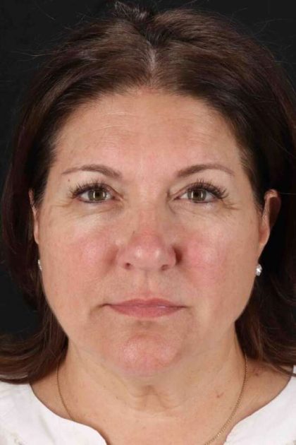 Co2 Laser Before & After Patient #3357