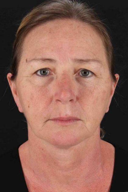 Co2 Laser Before & After Patient #3368