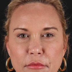Co2 Laser Before & After Patient #3390