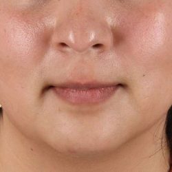 Submental Liposuction Before & After Patient #3412
