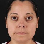 Buccal Fat Pad Before & After Patient #1436