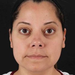 Buccal Fat Pad Before & After Patient #1436
