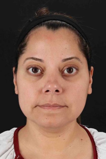 Buccal Fat Pad Before & After Patient #1436