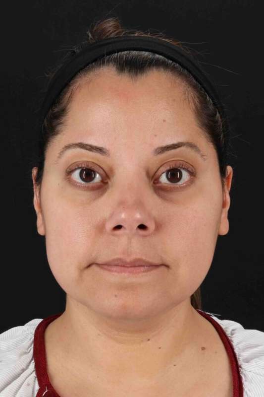 Buccal Fat Pad Before & After Patient #1436