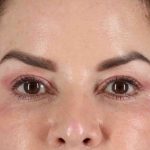 Upper Blepharoplasty Before & After Patient #3445
