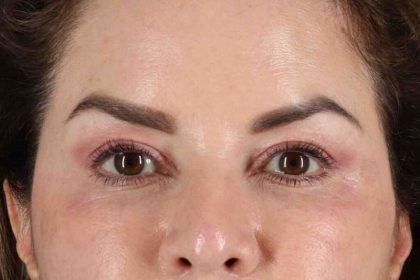 Upper Blepharoplasty Before & After Patient #3445