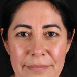 Upper Blepharoplasty Before & After Patient #3456