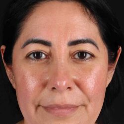 Upper Blepharoplasty Before & After Patient #3456