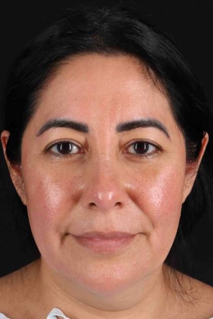 Upper Blepharoplasty Before & After Patient #3456