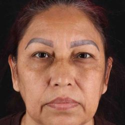 Upper Blepharoplasty Before & After Patient #3467