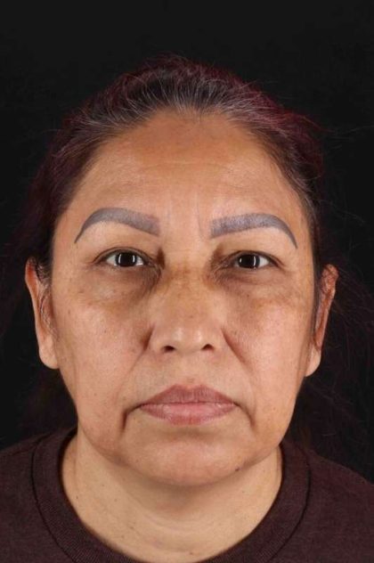 Upper Blepharoplasty Before & After Patient #3467