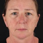 Upper Blepharoplasty Before & After Patient #3478