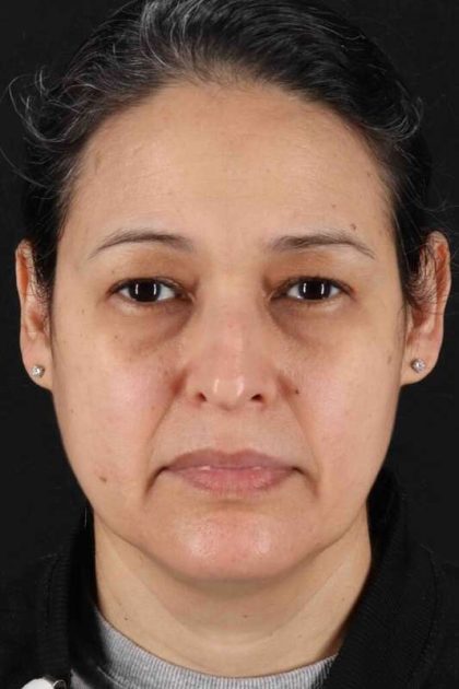 Upper Blepharoplasty Before & After Patient #3511