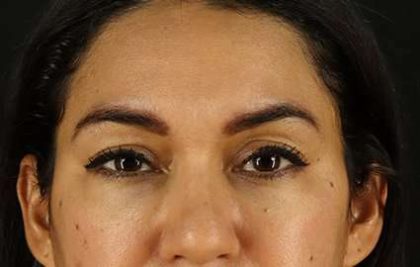 Upper Blepharoplasty Before & After Patient #3522