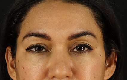 Upper Blepharoplasty Before & After Patient #3522