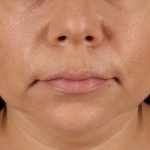 Facelift Before & After Patient #3555