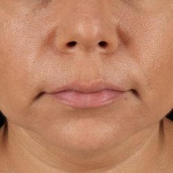Facelift Before & After Patient #3555
