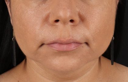 Facelift Before & After Patient #3555