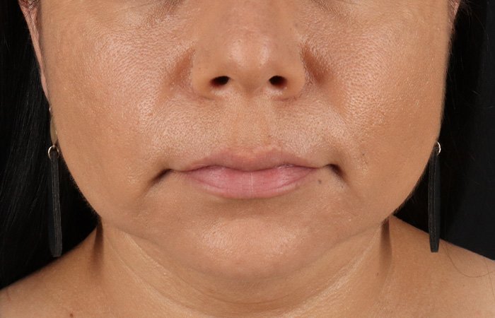 Facelift Before & After Patient #3555