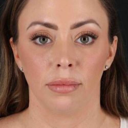 Buccal Fat Pad Before & After Patient #1447