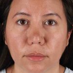 Buccal Fat Pad Before & After Patient #1458