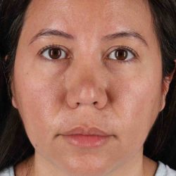 Buccal Fat Pad Before & After Patient #1458