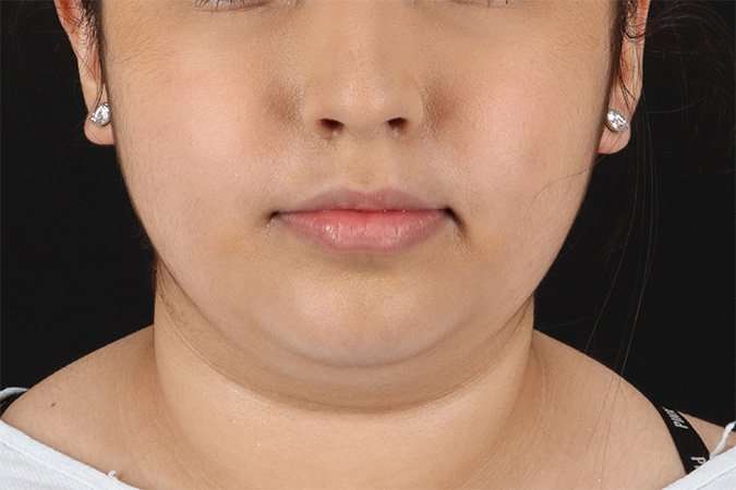 Buccal Fat Pad Before & After Patient #1469