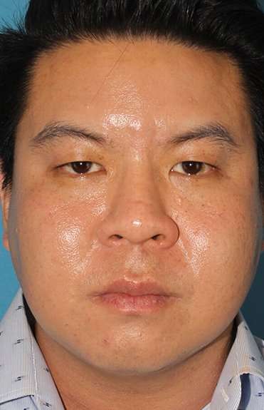 Buccal Fat Pad Before & After Patient #1474