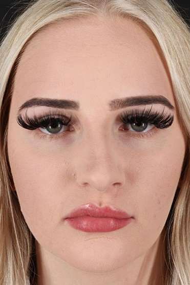 Browlift Before & After Patient #1242