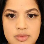 Buccal Fat Pad Before & After Patient #1485