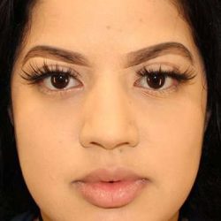 Buccal Fat Pad Before & After Patient #1485