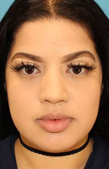 Buccal Fat Pad Before & After Patient #1485