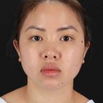 Chin Implant Before & After Patient #1507