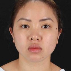 Chin Implant Before & After Patient #1507