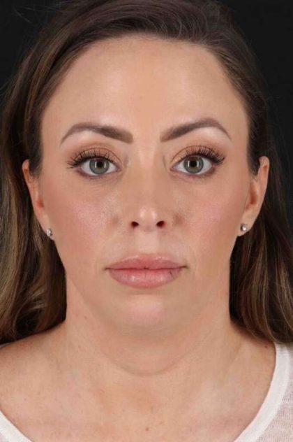 Chin Implant Before & After Patient #1518