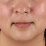 Chin Implant Before & After Patient #1529