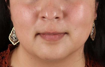 Chin Implant Before & After Patient #1529