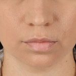 Chin Implant Before & After Patient #1540