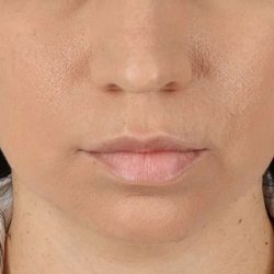 Chin Implant Before & After Patient #1540
