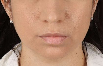 Chin Implant Before & After Patient #1540