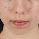 Chin Implant Before & After Patient #1551
