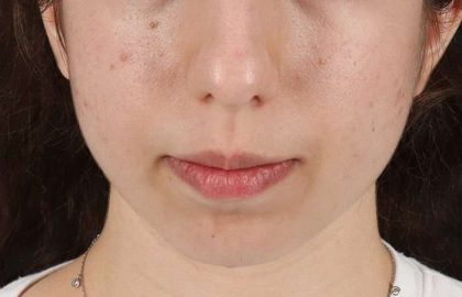 Chin Implant Before & After Patient #1551