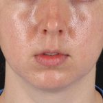 Chin Implant Before & After Patient #1562