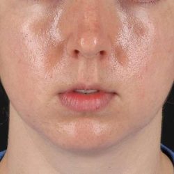 Chin Implant Before & After Patient #1562