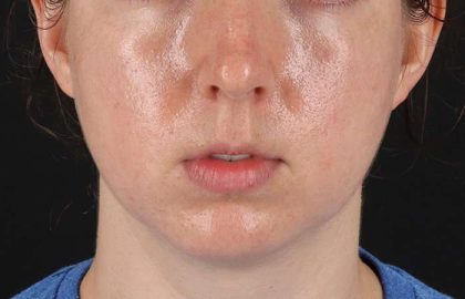 Chin Implant Before & After Patient #1562